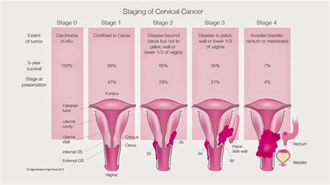 Cervical Cancer Carcinoma In Situ