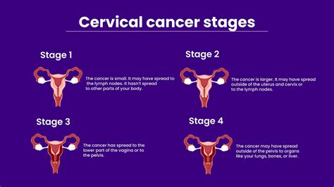 Cervical Cancer Treatment - Radiologyinfo.org