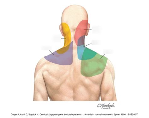 Cervical Facet Joint Referral Patterns Diagram Quizlet
