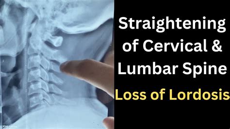 Cervical Lordosis Straightening