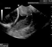 Cervical incompetence Radiology Reference Article