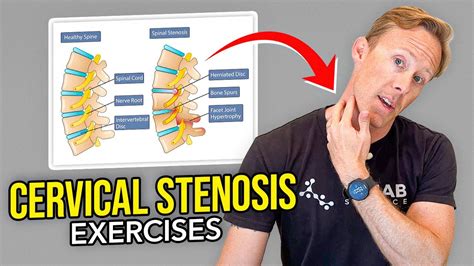 Cervical spinal stenosis Symptoms treatment and exercises