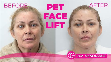 Cosmetic surgery center CG Cosmetic has launched the Face PET Lift, a new procedure that utilizes technology to enhance and lift facial features. PET stands for Point of Elevation Tissue, a patented method that allows for precise and natural-looking results. With this procedure, patients can achieve a more youthful appearance without the need .... 