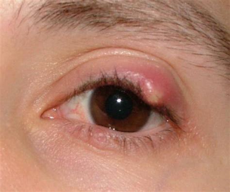 Chalazion hund