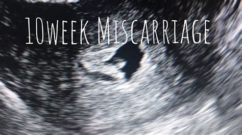 Chance of miscarriage at 10 weeks. Things To Know About Chance of miscarriage at 10 weeks. 