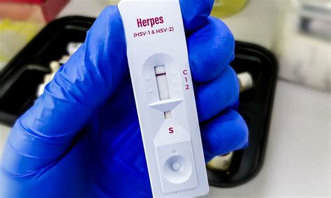 Chances of Getting Herpes – STD Testing Facilities