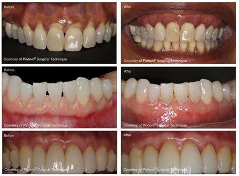 Chao Pinhole Technique & Surgery in Daytona Beach, FL