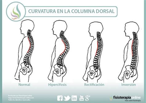 Chapter 168: Hipercifosis de la columna vertebral torácica