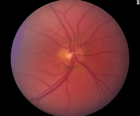 Chapter 6. The glaucoma eye examination and diagnosis