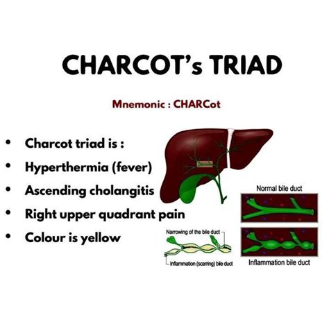 History In 1877, Charcot described cholangitis as a triad of findings of right upper quadrant (RUQ) pain, fever, and jaundice. The Reynolds pentad adds mental status changes and sepsis to.... 