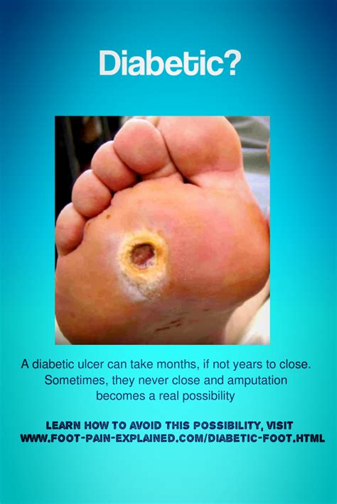 Charcot Foot and Diabetes - Symptoms, Causes, Treatment