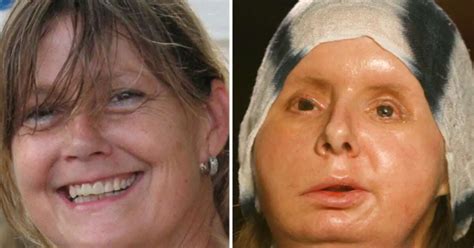 Charla Nash spoke about the isolation she feels but added she was determined to get better regardless. “I've never been a quitter,” she said. And now, three years after her face transplant .... 