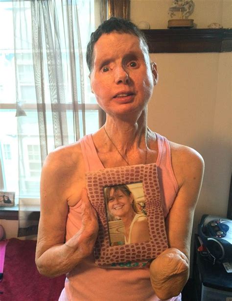 Charla Nash was mauled by a pet chimp in 2009 and underwent a face transplant, which her body is now rejecting. Nash was mauled nearly to death by her friend Sandy Herold’s pet chimpanzee Travis .... 