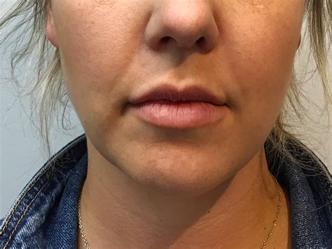 Charlotte skin and laser. Laser treatments with our Limelight IPL system can tighten the skin, lighten dark spots, stimulate collagen production, decrease redness, and erase visible veins on the face and body. Limelight treatment addresses uneven pigmentation, redness, sun damage, and surface imperfections on the face and upper body, including the neck, chest, arms, and … 