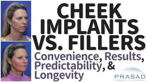 Cheek implants vs fillers.  Temporary or Permanent Options &ndash; Injectable fille...