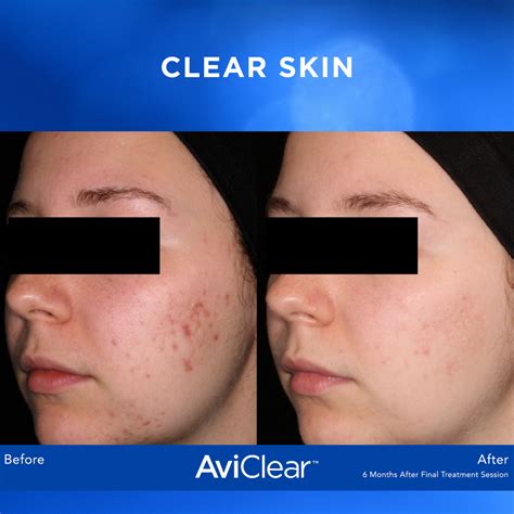 Chemical Peels for Greater Houston, TX DermSurgery Associates