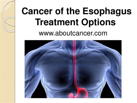 Chemotherapy treatment Oesophageal cancer Cancer …