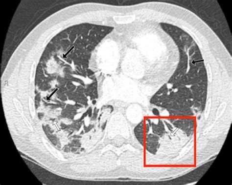 Chest CT in COVID-19 pneumonia: what are the findings in mid …