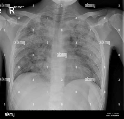 Chest Xray in a patient with disseminated TB showing the... Download