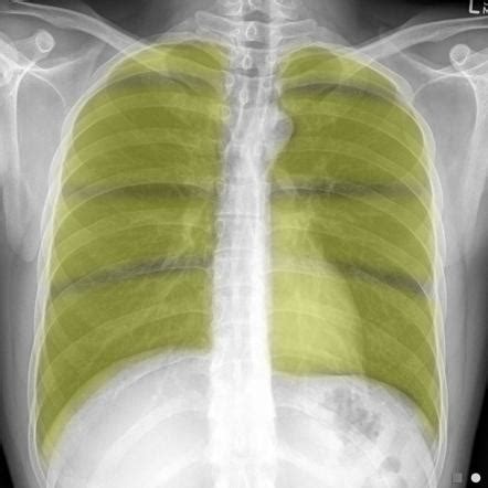 Chest radiograph zones Radiology Reference Article - Radiopaedia