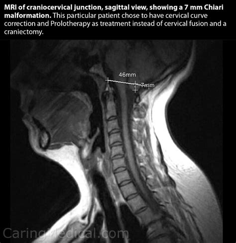 Chiari Malformation and EDS - Ehlers-Danlos Syndromes