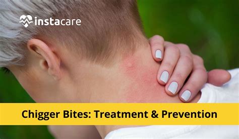 Chiggers Bites, Rash, Treatment and Eradication - Phaa.com