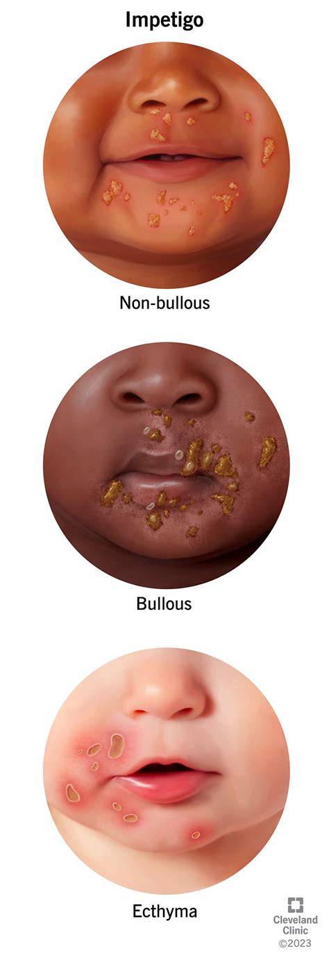 Child skin infection.  Types include bullous, non-bullous, and ecthyma.  ...