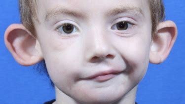 Children with Facial Asymmetry - HealthyChildren.org