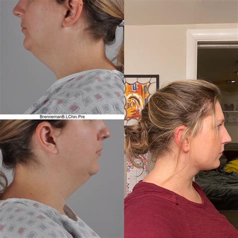 Chin Surgery consult : r/PlasticSurgery - Reddit