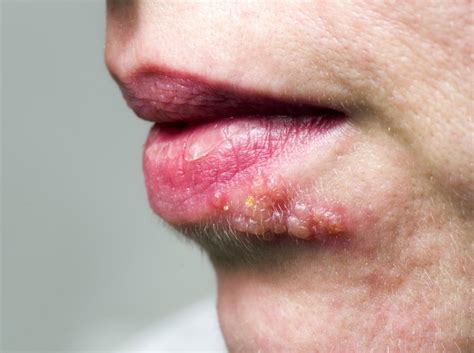 Chingles - Jan 31, 2024 · Shingles is a painful condition caused by the same virus that causes chickenpox. If you notice clusters of small red patches or blisters on your skin, you may have the early symptoms of shingles ...