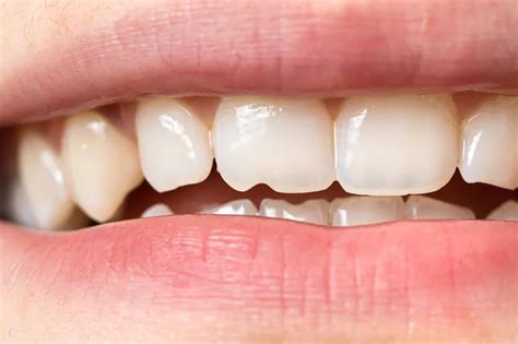 Chipped Tooth Options Mastrick Dental