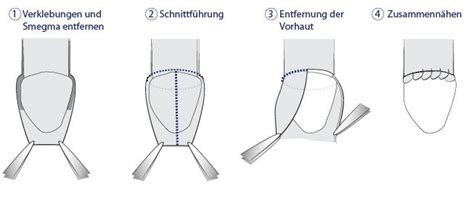 Chirurgische anleitung zur beschneidung von david a bolnick. - Guide for the chiropractic acupuncture exam a comprehensive study aid for the nbce acupuncture examination.