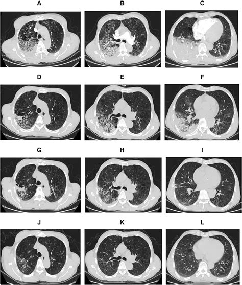 Chlamydia Psittaci Pneumonia IDR