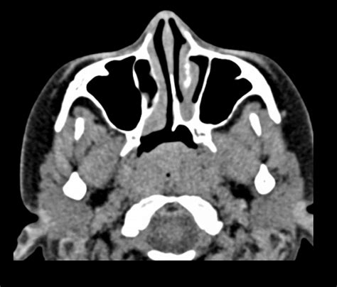 Choanal atresia Radiology Case Radiopaedia.org