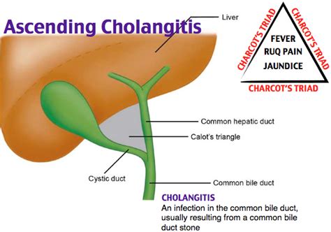 Presentations of cholangitis The following make up the classical ‘Charcot’s triad’ Jaundice Fever RUQ pain - severe o Shock (due to sepsis) and confusion added to Charcot’s triad = Reynold’s pentad Jaundice may not always be present, especially if a patient already has a biliary stent in situ PMHx. 