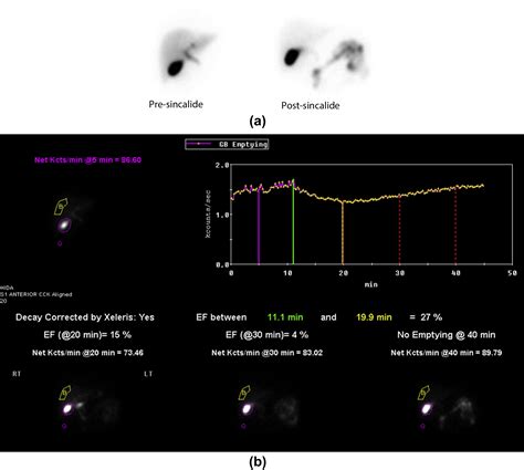 Cholecystokinin (CCK)-HIDA scintigraphy in patients with ... - PubMed