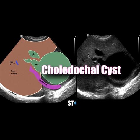 Choledochal Cyst – Sonographic Tendencies