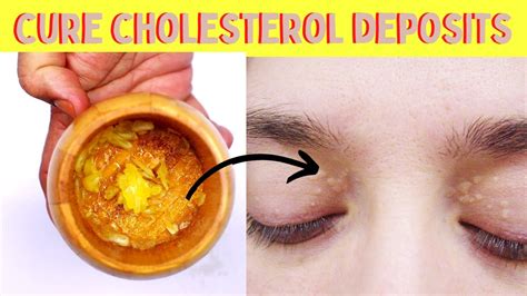 Cholesterol Deposits Removal