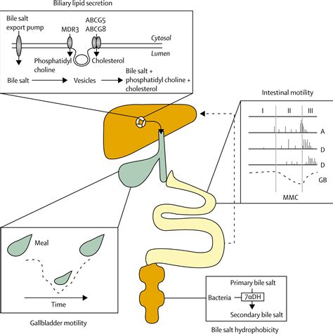 Cholesterol gallstone disease - The Lancet