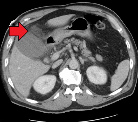 Cholezystitis – Wikipedia