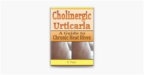 Cholinergic urticaria a guide to chronic heat hives. - 2003 mazda drifter b2500 workshop manual.