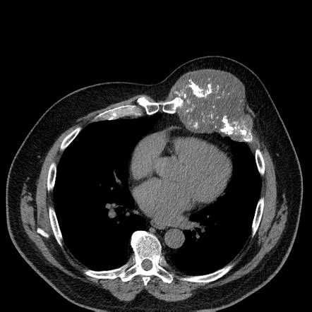 Chondrosarcoma of a rib - ScienceDirect