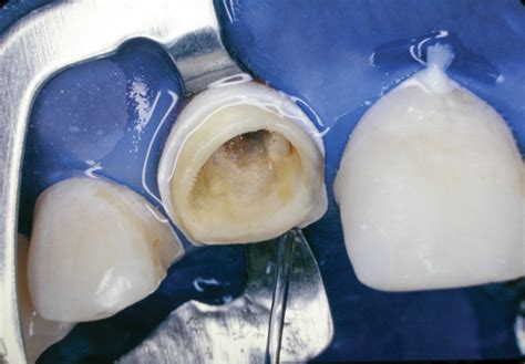 Choosing an Endodontic Post System Inside Dentistry