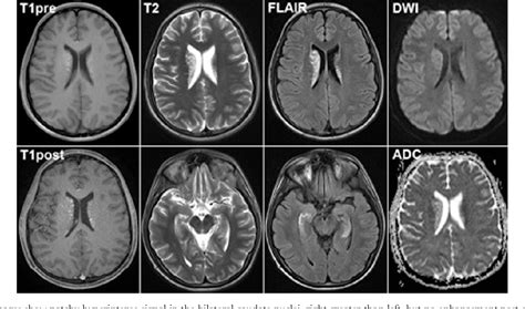 Chorea-ballism associated with nonketotic ... - ScienceDirect