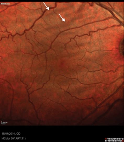 Choroidal folds Eye News