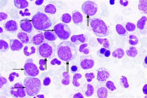 Chronic Myelomonocytic Leukemia (CMML): Symptoms and More