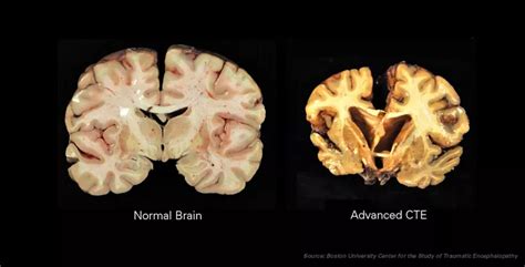 Chronic Traumatic Encephalopathy (CTE) Quick Facts