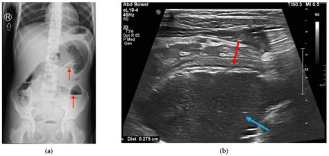 Chronic appendicitis webmd.  Oct 10, 2025 · Peritonitis - a potentially fatal ...