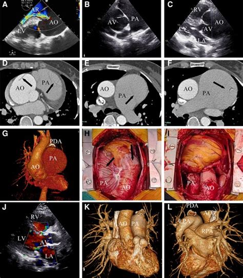 Chronic concomitant pulmonary artery and aortic dissection …