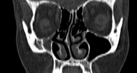 Chronic maxillary atelectasis Radiology Reference Article ...